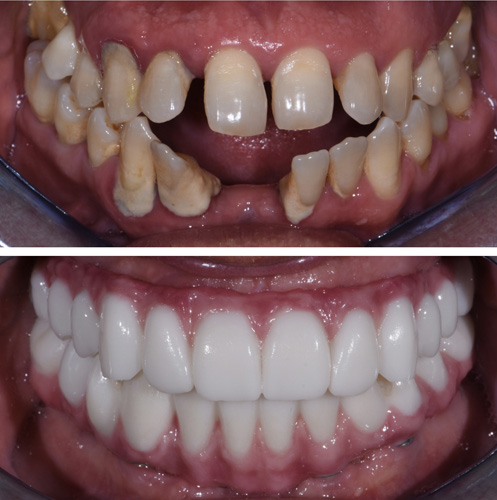 Before and after smile transformation at Smile Spa Camarillo Dentistry — case 22