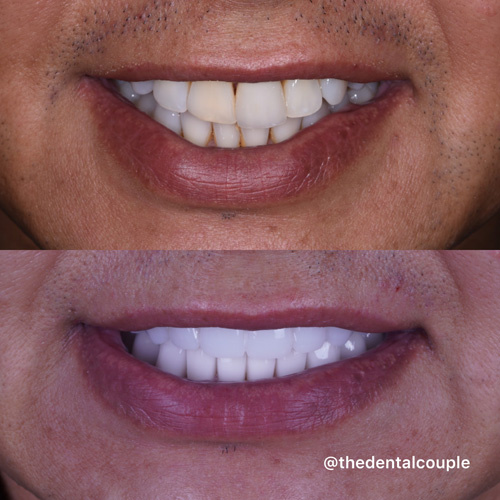 Before and after smile transformation at Smile Spa Camarillo Dentistry — case 23