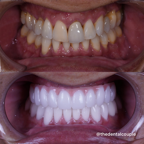 Before and after smile transformation at Smile Spa Camarillo Dentistry — case 24