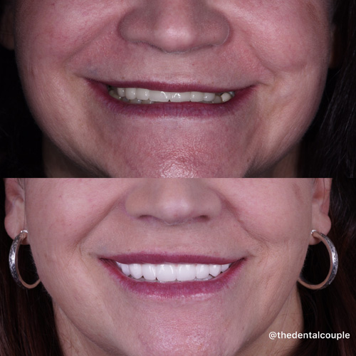 Before and after smile transformation at Smile Spa Camarillo Dentistry — case 25