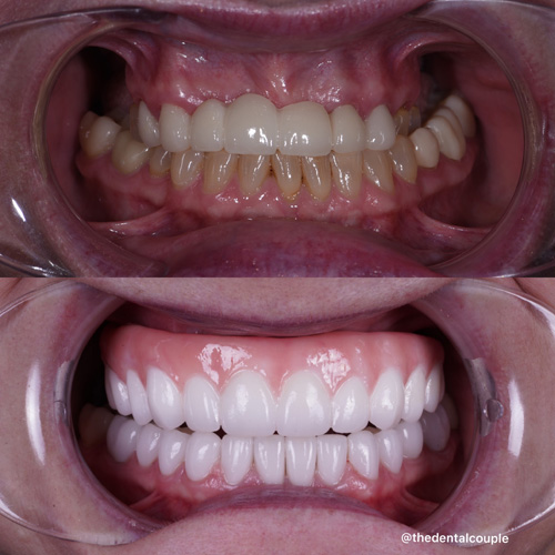 Before and after smile transformation at Smile Spa Camarillo Dentistry — case 26