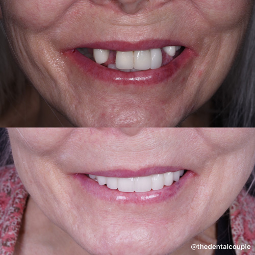 Before and after smile transformation at Smile Spa Camarillo Dentistry — case 28