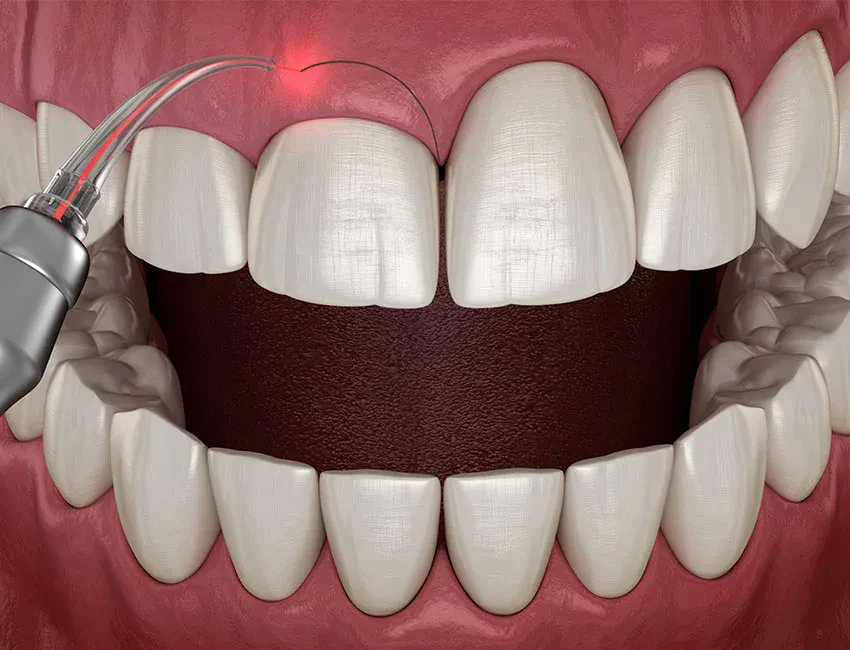 Can You Fix a Gummy Smile With Cosmetic Dentistry?