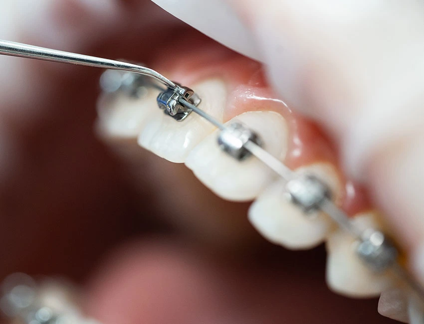 Orthodontics-braces.webp