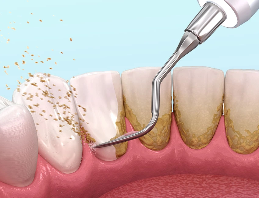Periodontics-teeth-cleaning.webp