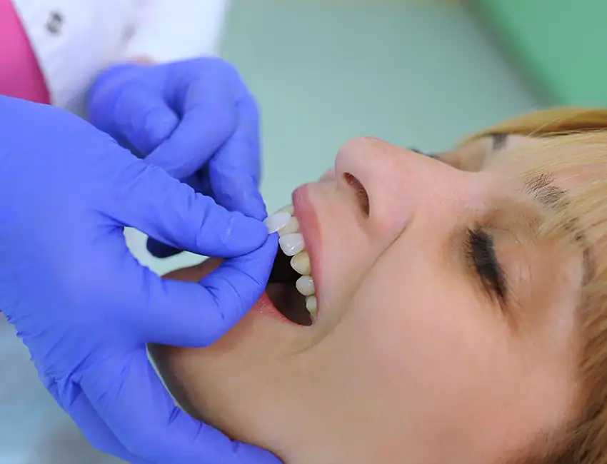 Porcelain-Dental-Veneers.webp