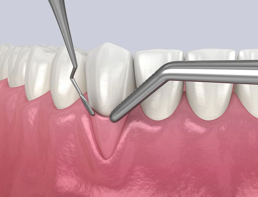 Soft-tissue-grafting.webp