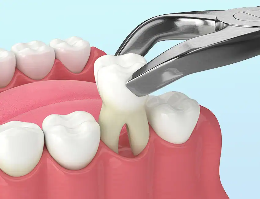 Wisdom Teeth Removal at Smile Spa Camarillo Dentistry