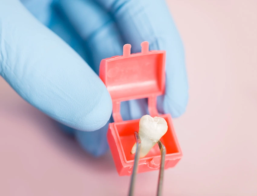 Wisdom-Teeth-removal.webp