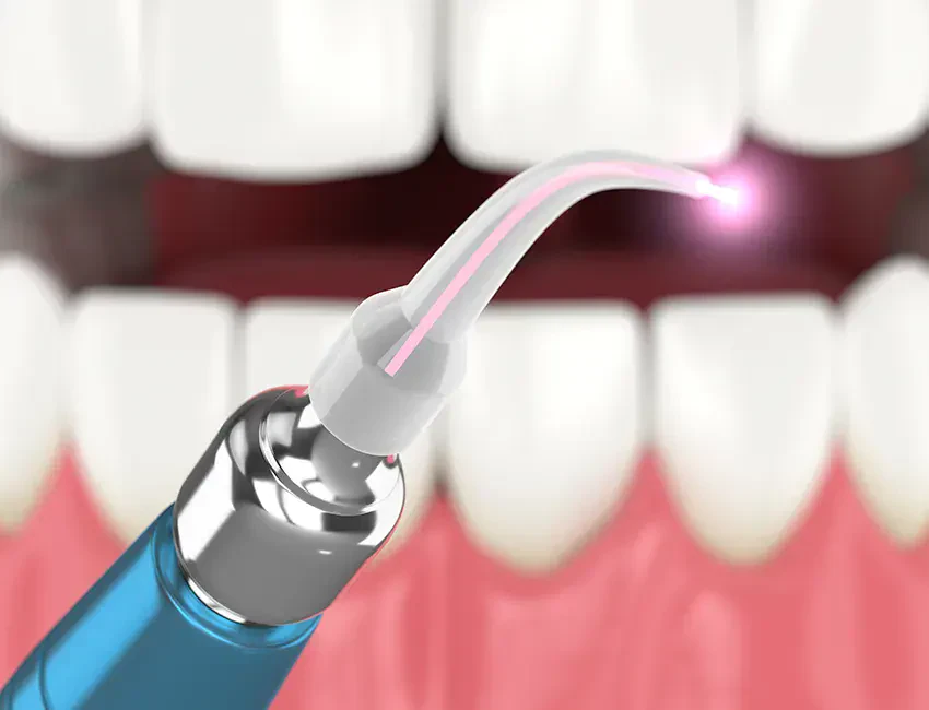 Laser Dentistry at Smile Spa Camarillo Dentistry