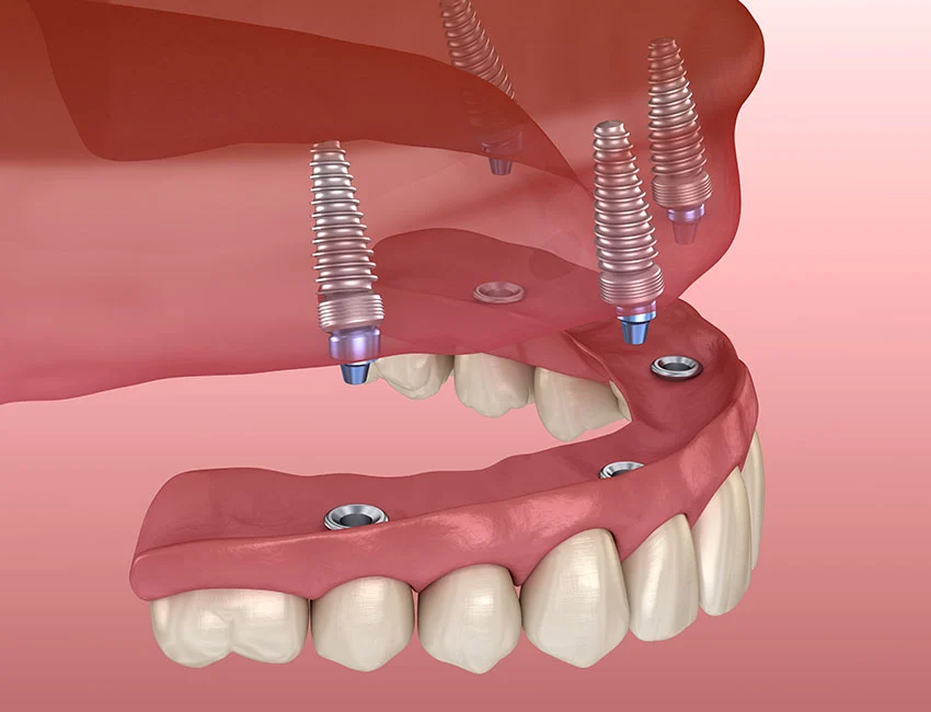 all-on-4-implants.webp