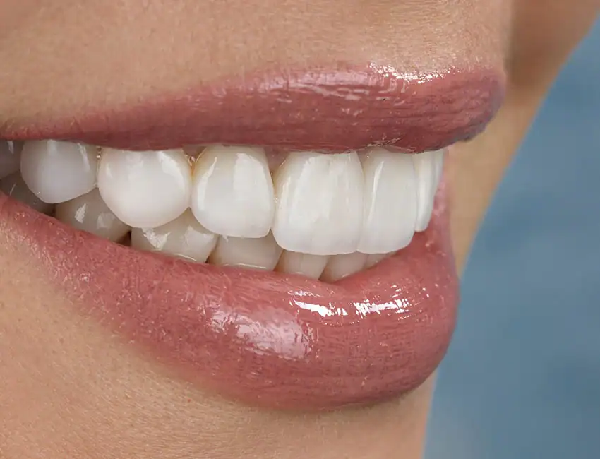 Dental Bonding at Smile Spa Camarillo Dentistry