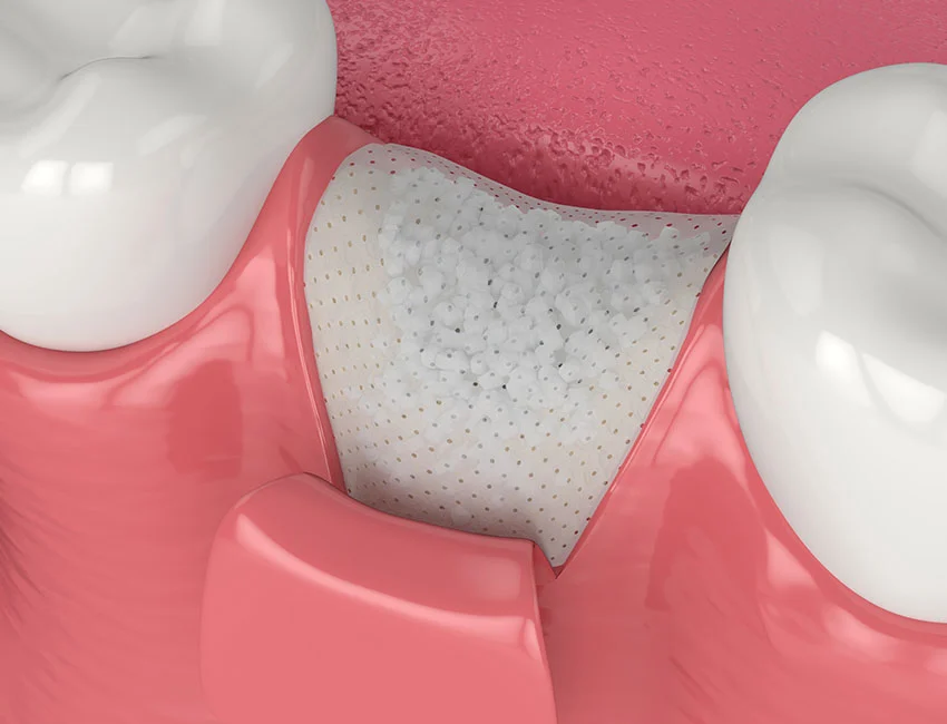 bone-graft.webp