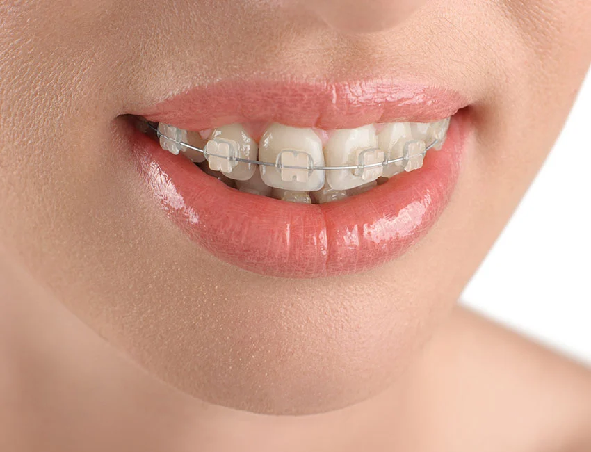 ceramic-braces-orthodontics.webp