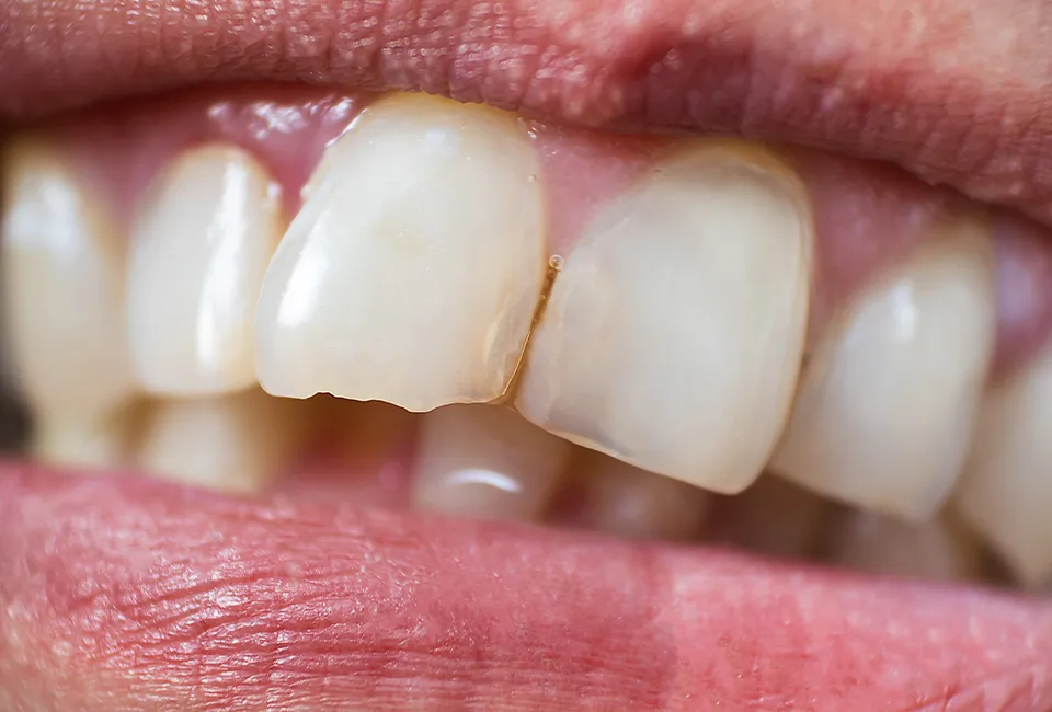 Chipped a Tooth? in Camarillo, CA