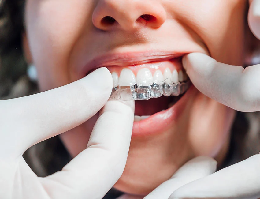 Crooked Teeth As An Adult? You Don't Have To Live With Them