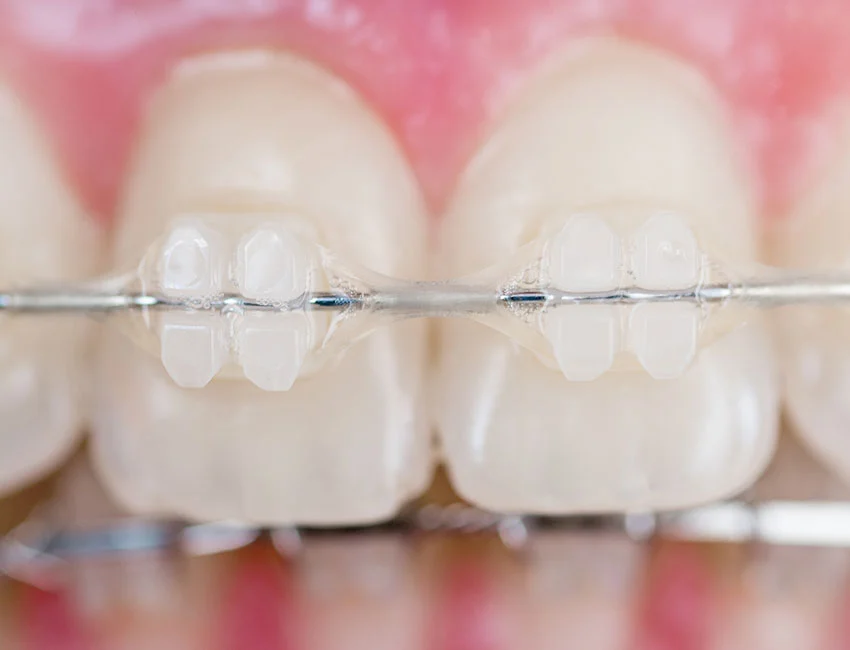 clear-braces.webp