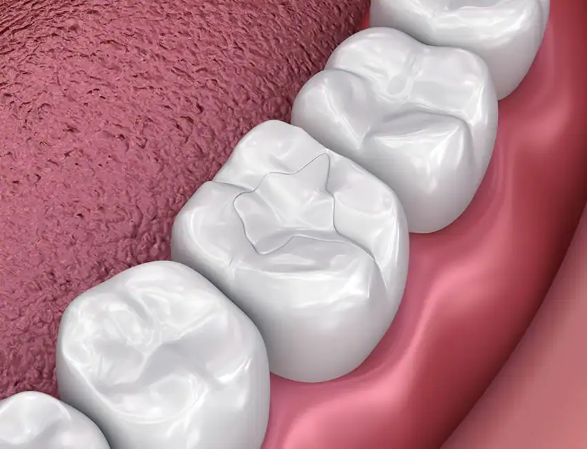 Dental Fillings at Smile Spa Camarillo Dentistry