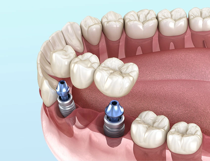 dental-bridge-implants.webp