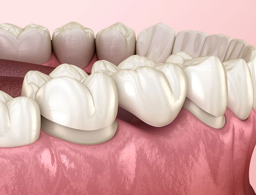 Dental Bridges at Smile Spa Camarillo Dentistry