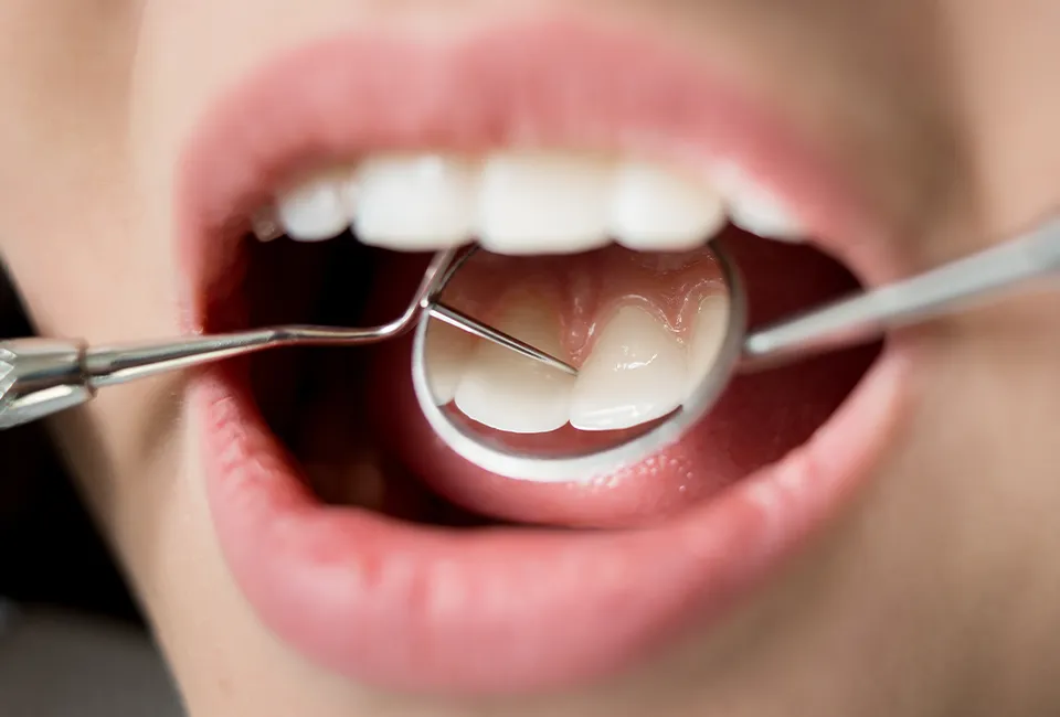 A patient receiving a fluoride treatment at Smile Spa Camarillo Dentistry