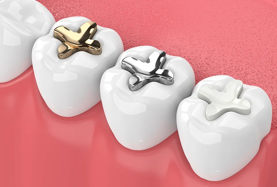 dental-fillings-types.webp