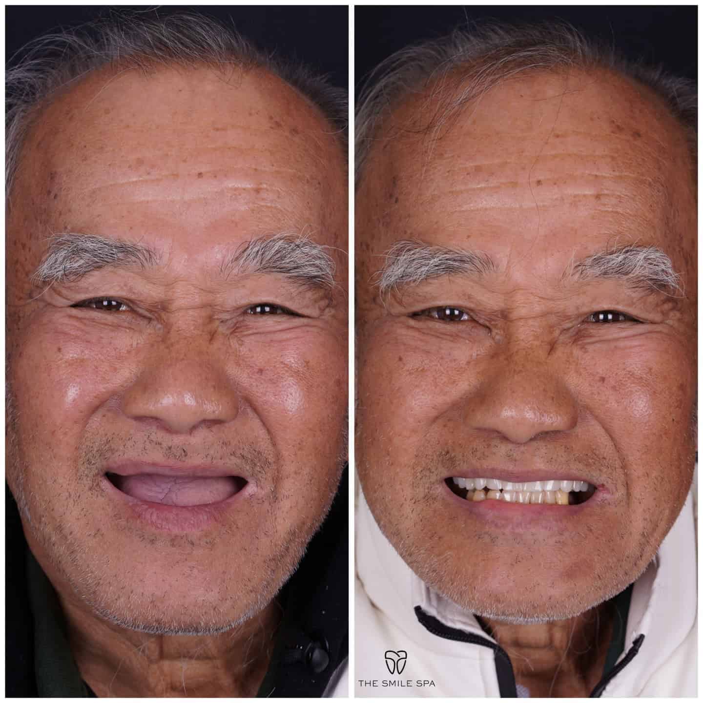 Before and after smile transformation at Smile Spa Camarillo Dentistry — case 29