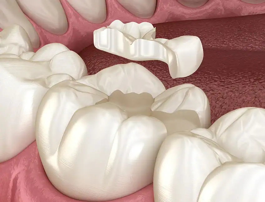 Inlays & Onlays at Smile Spa Camarillo Dentistry