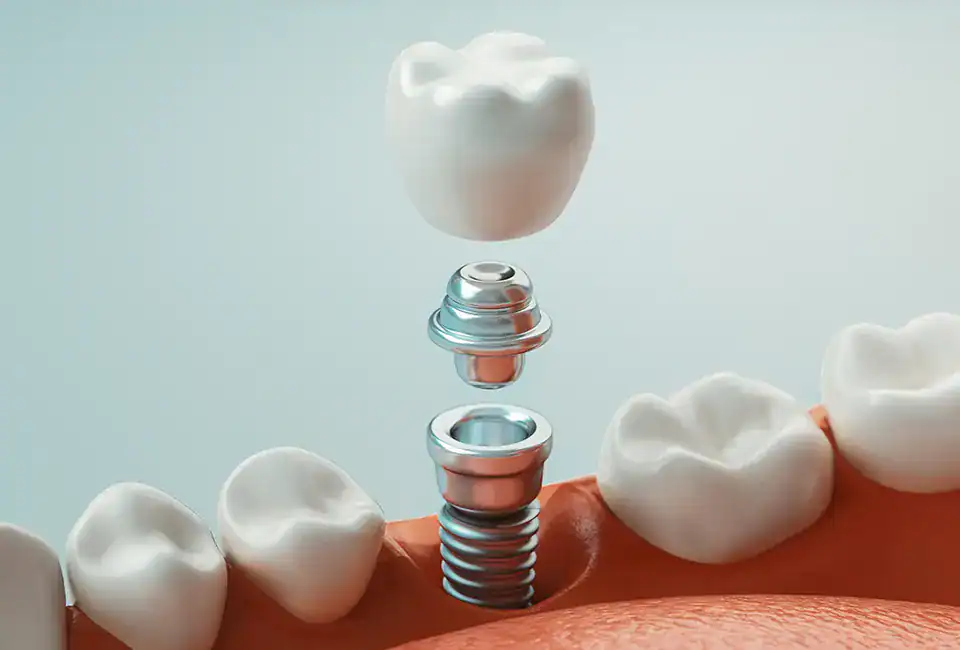 Does a Missing Tooth Make You Look Older Than You Are?