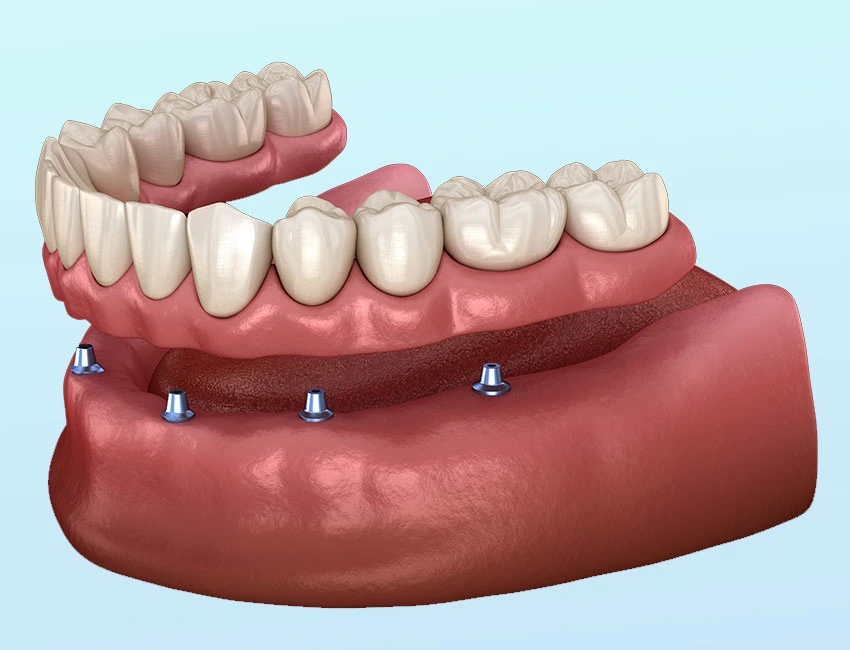 denture-supported-implants-snap-on-2.webp