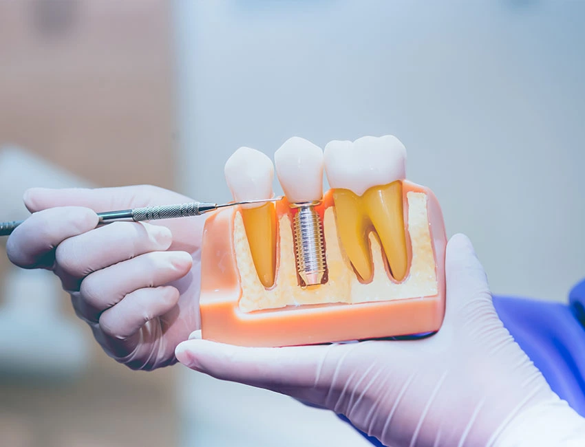How to Care for Dental Implants: A Long-Term Maintenance Guide