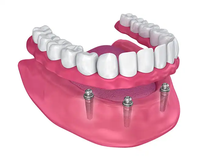 Implant-Supported Dentures
