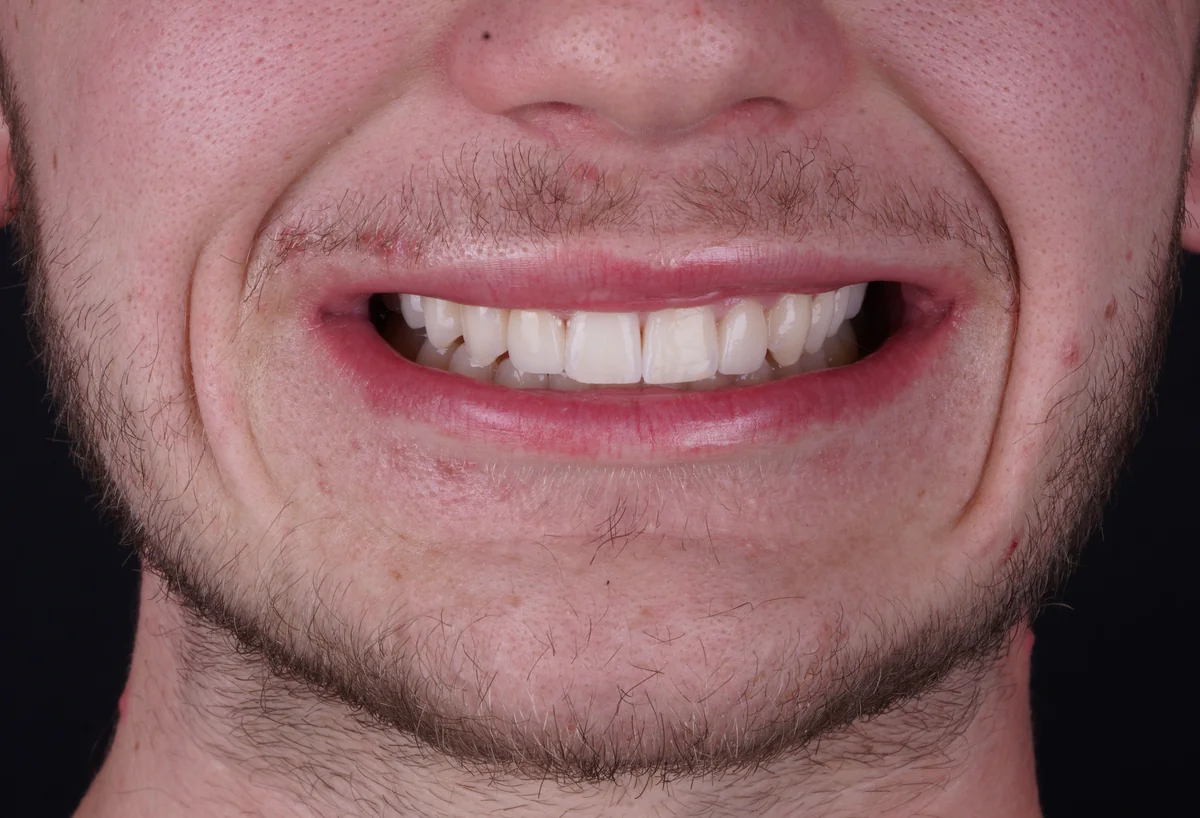 Invisalign® patient after treatment at Smile Spa Camarillo Dentistry