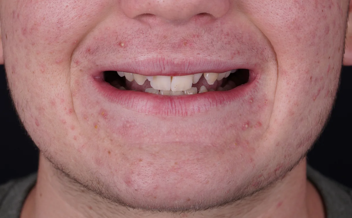 Invisalign® patient before treatment at Smile Spa Camarillo Dentistry