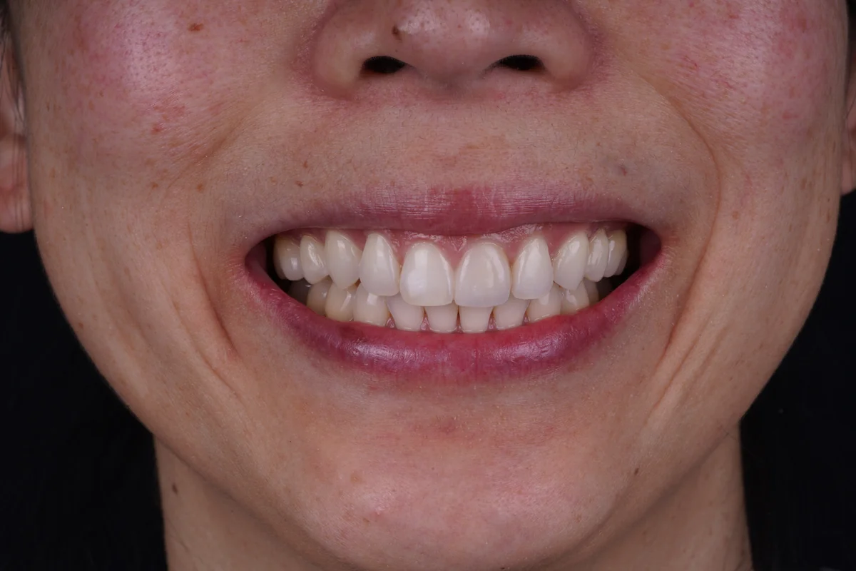 Invisalign® patient after treatment at Smile Spa Camarillo Dentistry
