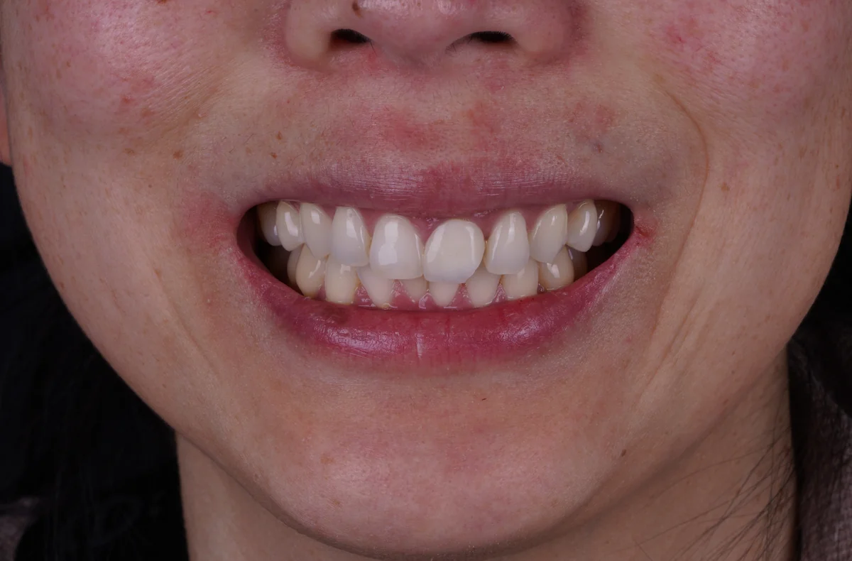 Invisalign® patient before treatment at Smile Spa Camarillo Dentistry