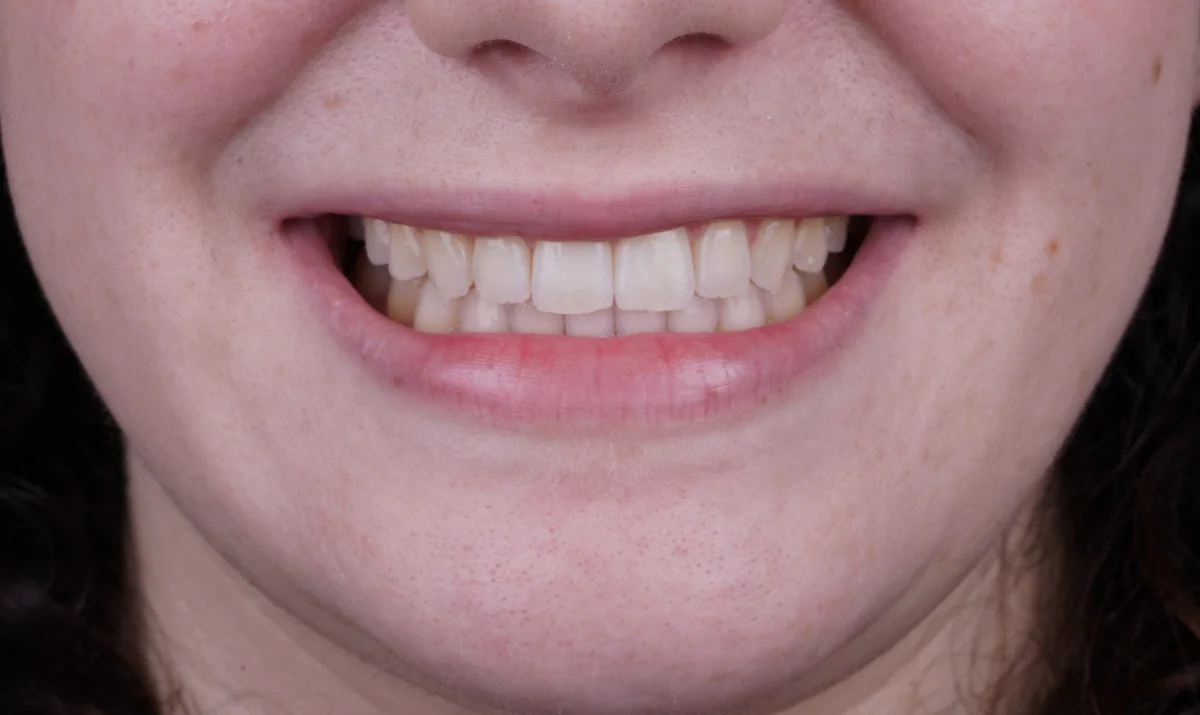 Invisalign® patient after treatment at Smile Spa Camarillo Dentistry