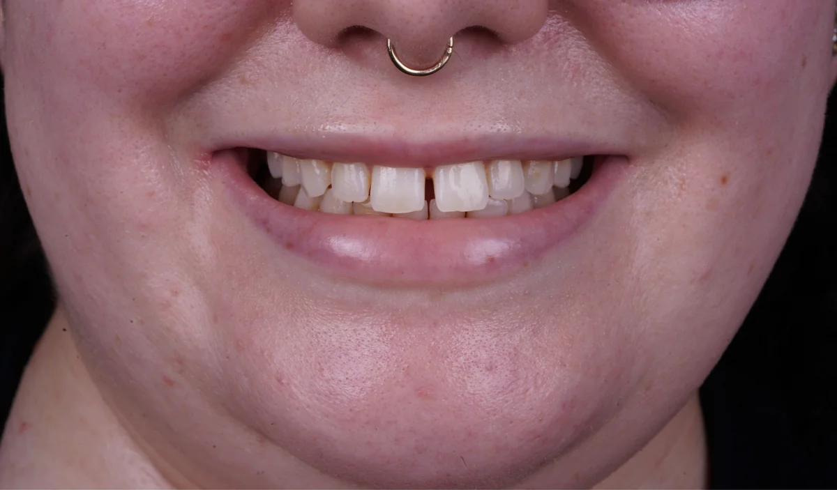 Invisalign® patient before treatment at Smile Spa Camarillo Dentistry