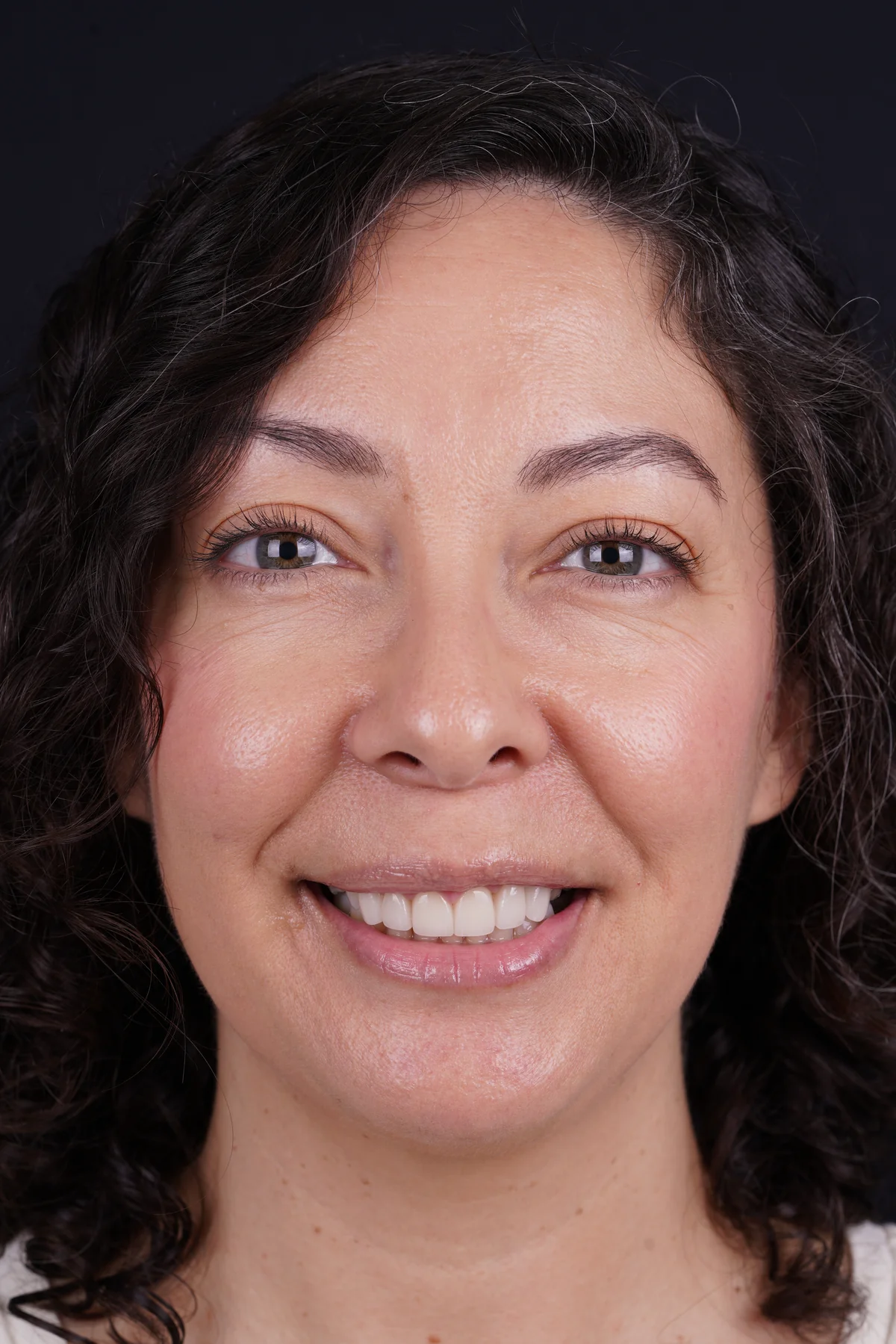 Invisalign® patient after treatment at Smile Spa Camarillo Dentistry