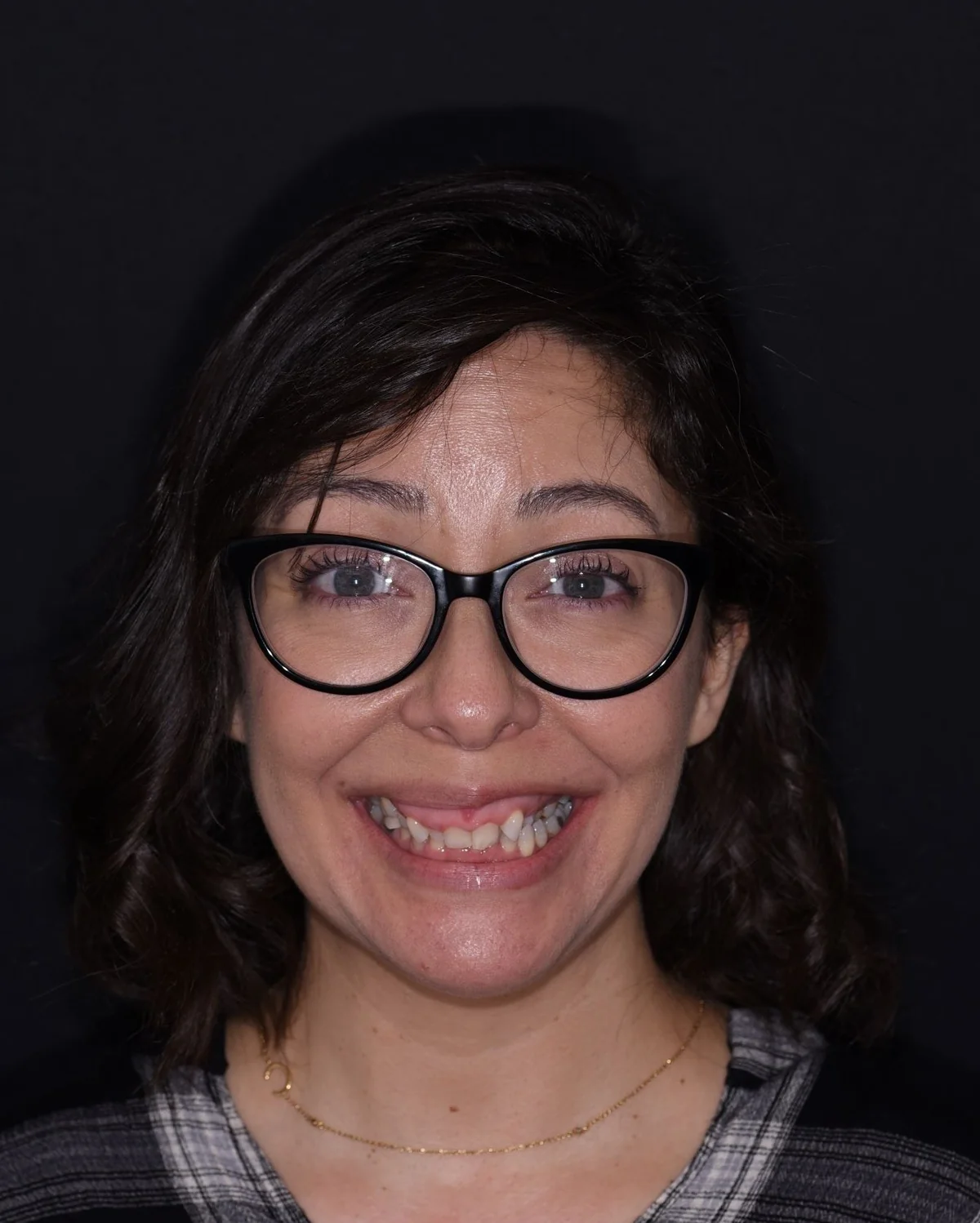 Invisalign® patient before treatment at Smile Spa Camarillo Dentistry