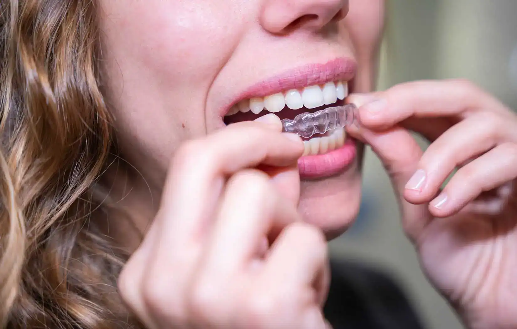 Orthodontics at Smile Spa Camarillo Dentistry in Camarillo, CA
