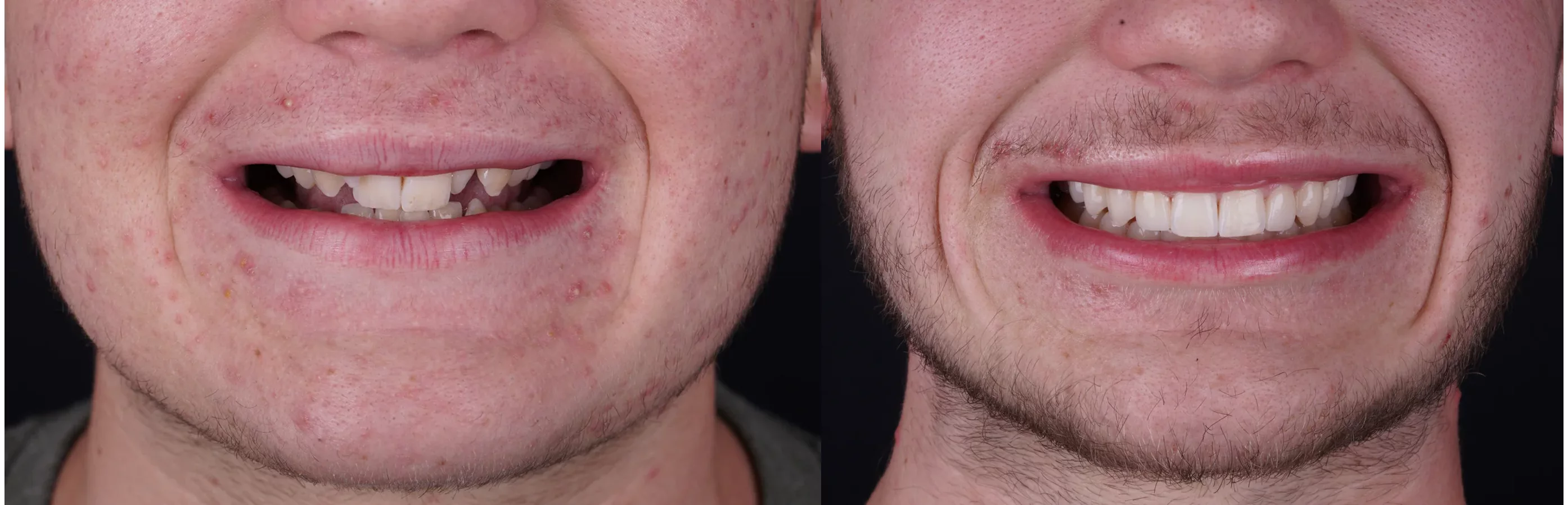 Invisalign clear aligners before and after at Smile Spa Camarillo Dentistry — case 1