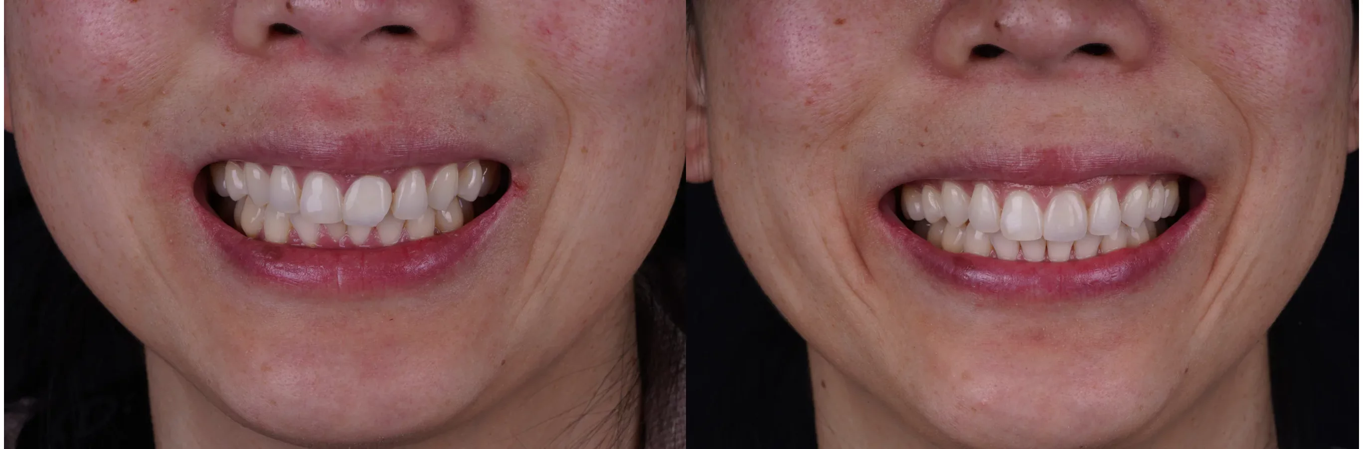 Invisalign clear aligners before and after at Smile Spa Camarillo Dentistry — case 2