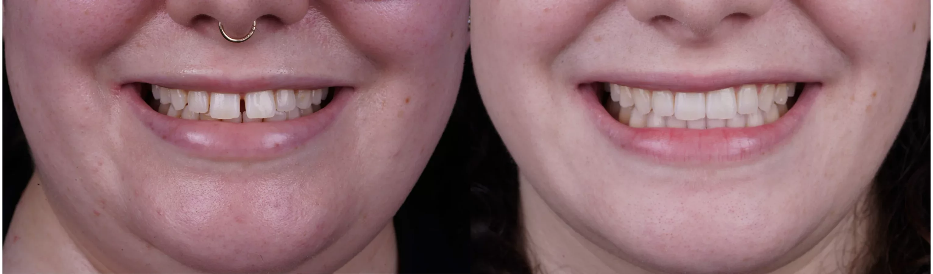 Invisalign clear aligners before and after at Smile Spa Camarillo Dentistry — case 3