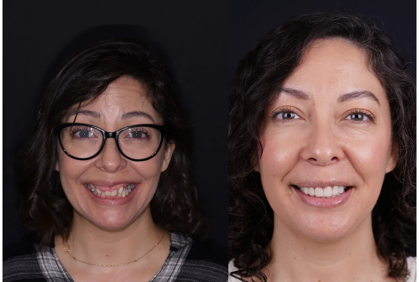 Invisalign clear aligners before and after at Smile Spa Camarillo Dentistry — case 4