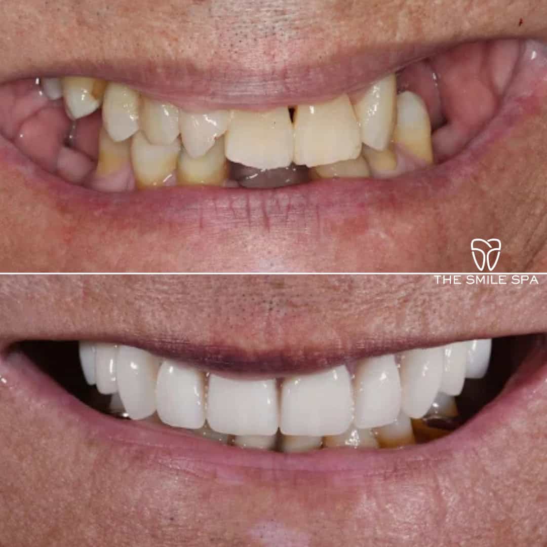 Before and after smile transformation at Smile Spa Camarillo Dentistry — case 2
