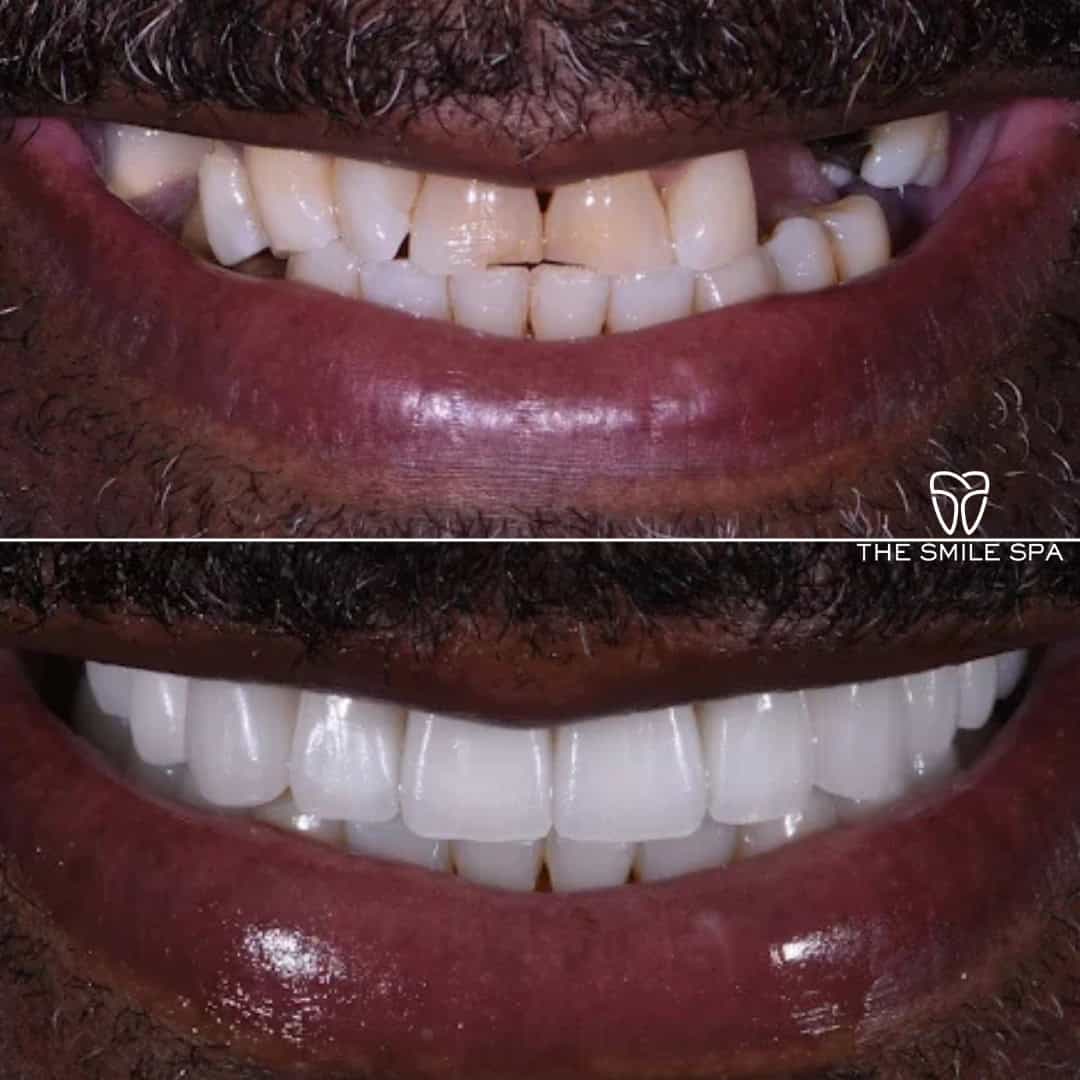 Before and after smile transformation at Smile Spa Camarillo Dentistry — case 3