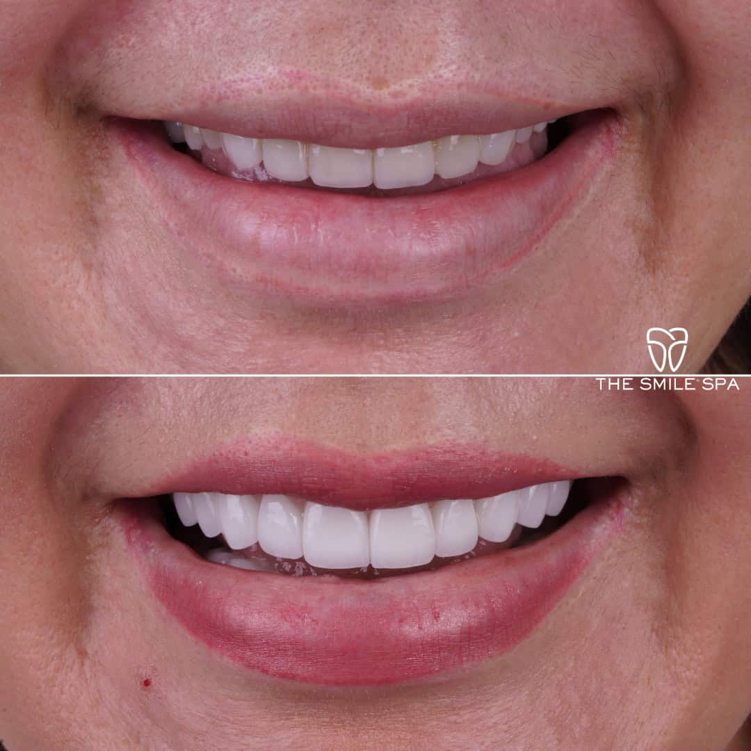 Before and after smile transformation at Smile Spa Camarillo Dentistry — case 1