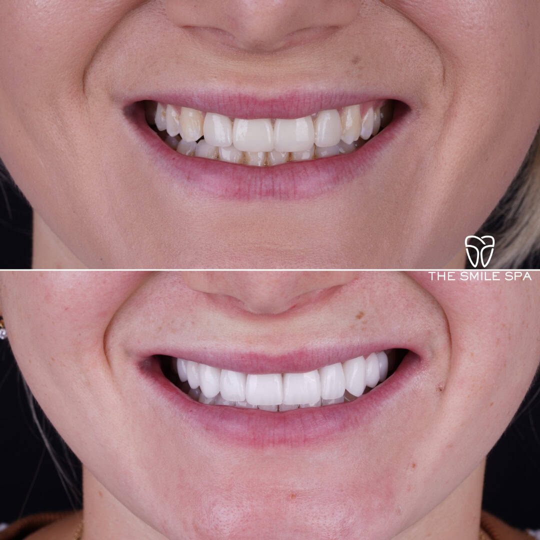 Before and after smile transformation at Smile Spa Camarillo Dentistry — case 19