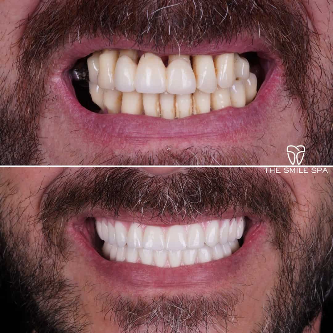 Before and after smile transformation at Smile Spa Camarillo Dentistry — case 20